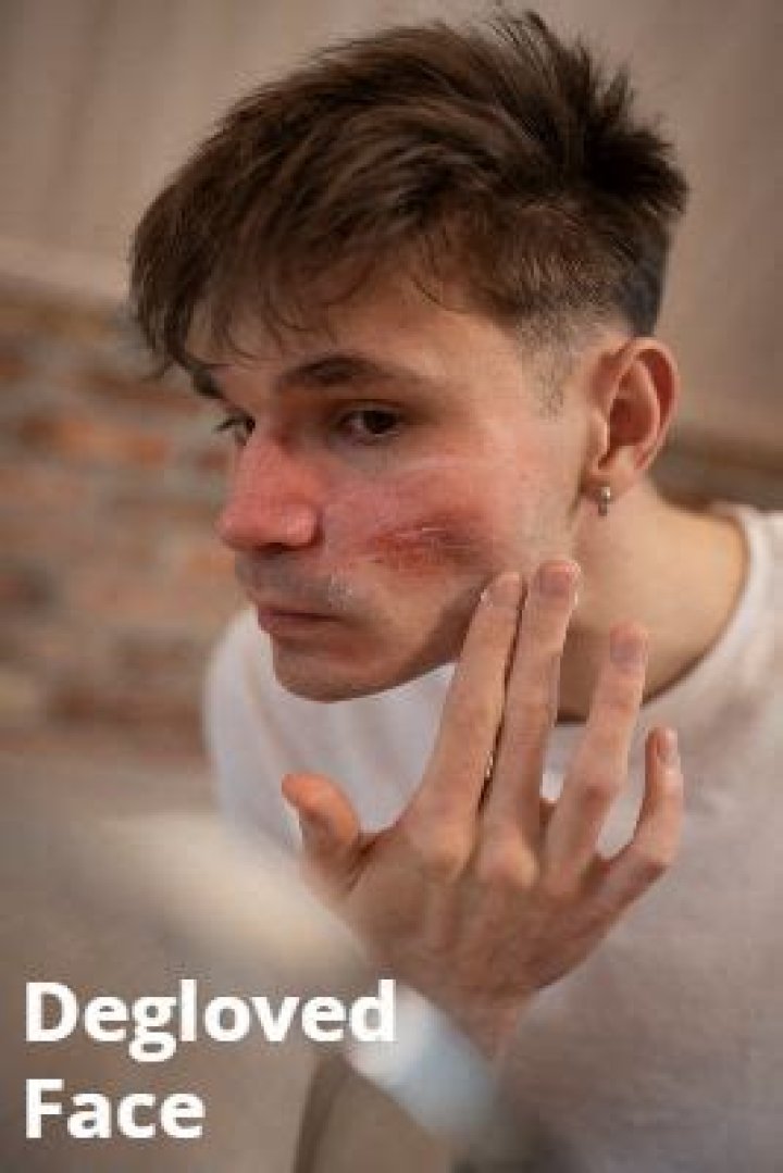 Understanding The Impact Of A Degloved Face: Causes, Treatments, And Recovery