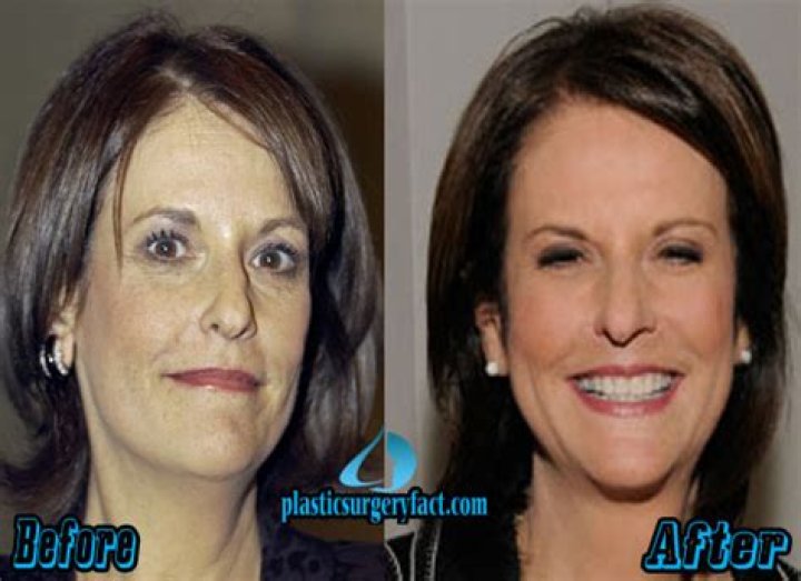 Understanding Gloria Borger's Health: Is Gloria Borger Well?