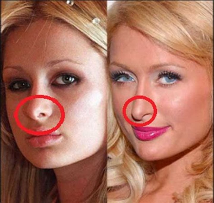Paris Hilton's Nose Surgery: A Before And After Analysis