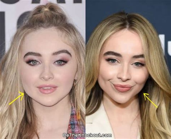 Exploring Sabrina Carpenter's Cheek Filler Transformation